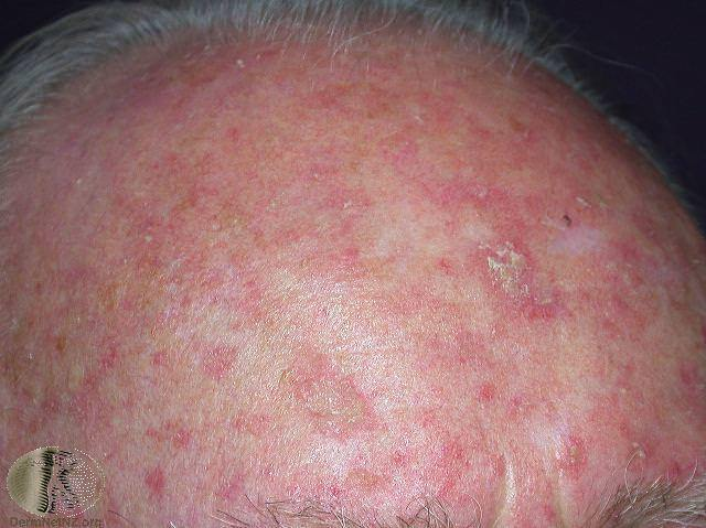 Clinical example of actinic keratoses on a sun-damaged scalp.