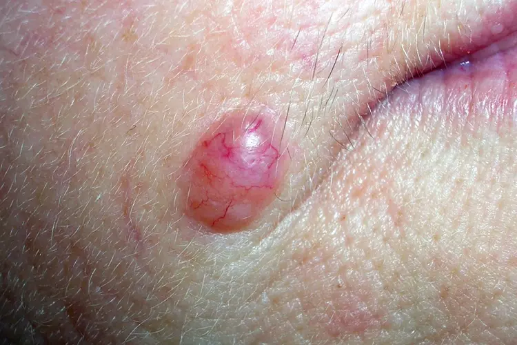Close-up clinical example of a pearly pink basal cell carcinoma with visible surface blood vessels.