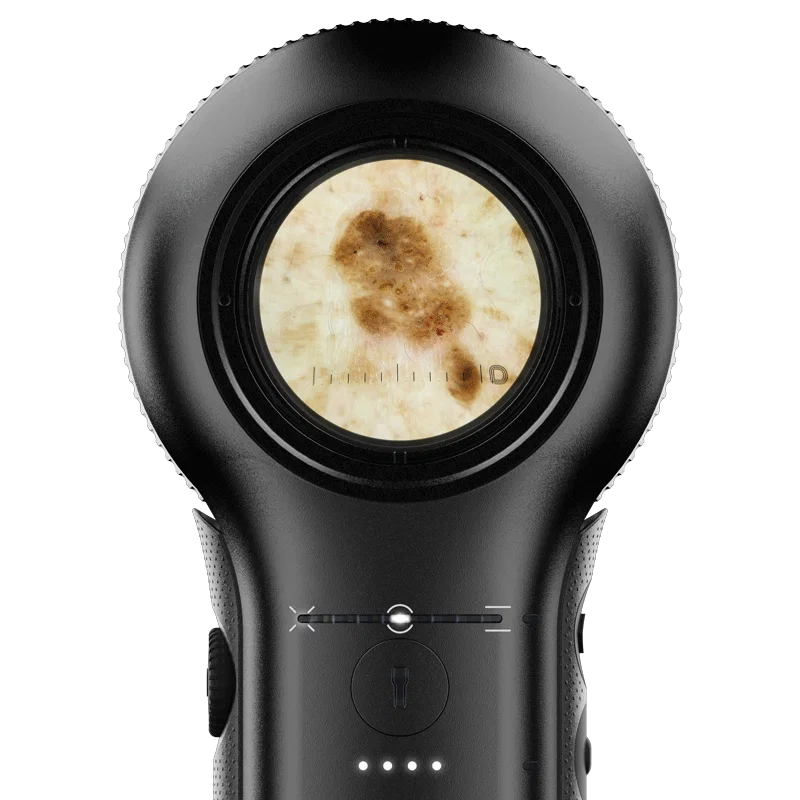 Handheld dermatoscope with magnified skin lesion view (reference image)