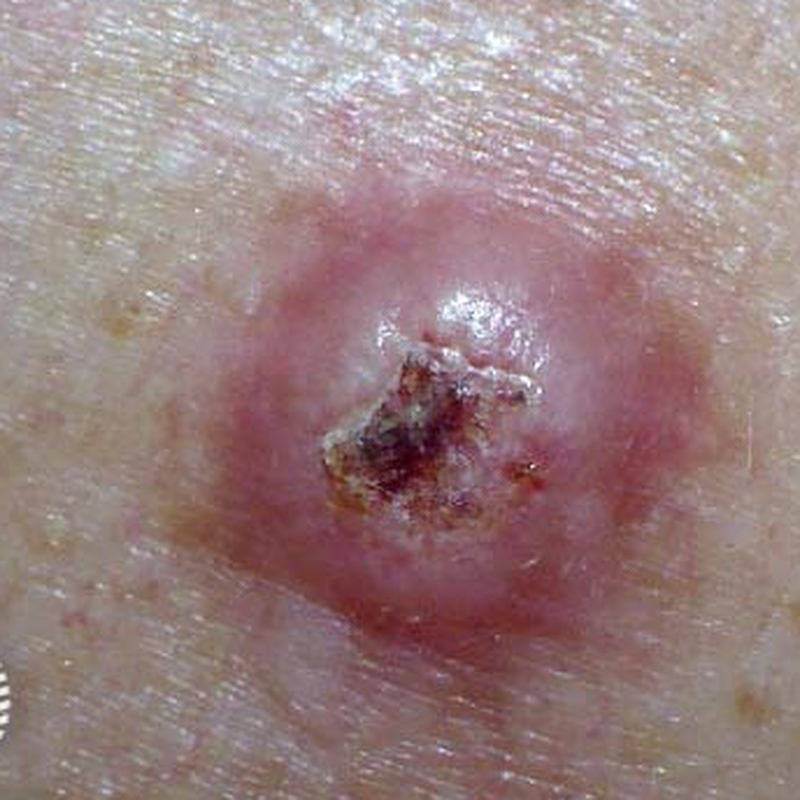Closer view of a raised pink squamous cell carcinoma with central crusting